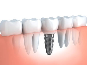 Dentist in Parsippany, NJ - Implants